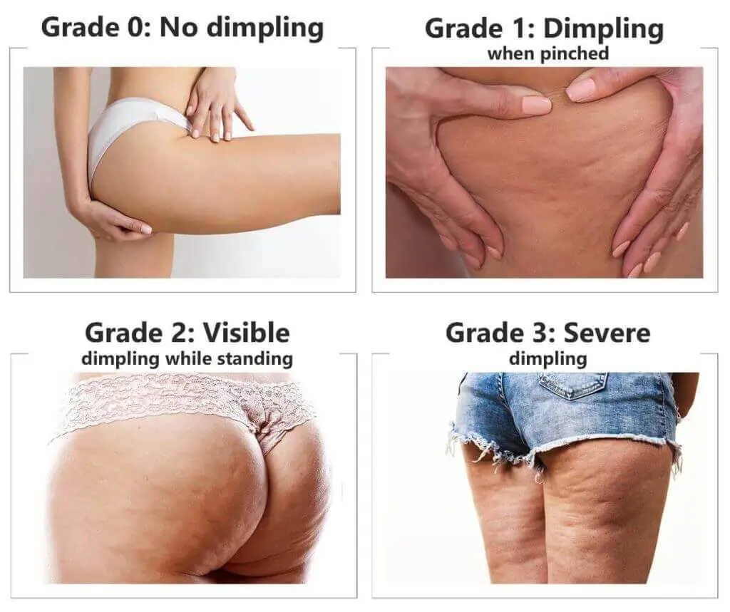 Representation of the stages of cellulite development Melksham